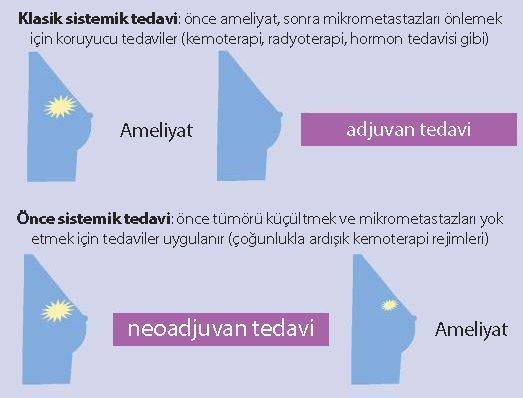 meme kanserinde neoadjuvan ve adjuvan tedavi karşılaştırması