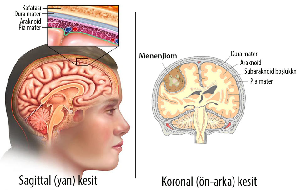 menenjiom nedir anatomisi dura pia araknoid mater beyin tümörü