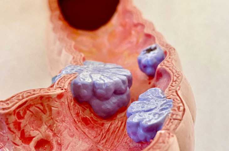 Metastatik Kolorektal Kanser 3. Basamak Tedavisinde Lonsurf ve Bevasizumab FDA Onayı Aldı
