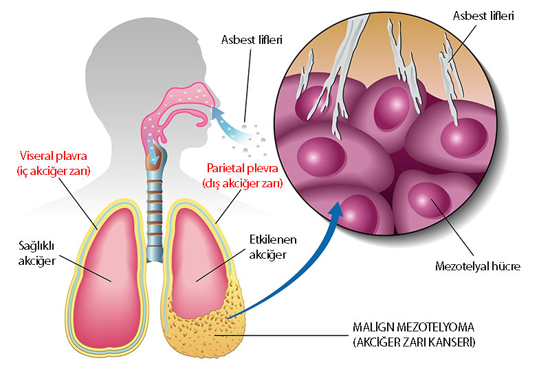 mezotelyoma nedir parietal viseral plevra