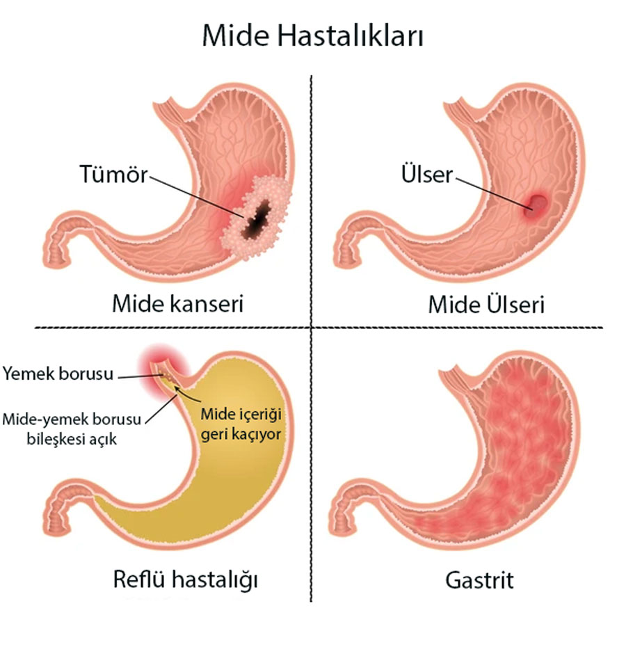 mide hastalıkları nelerdir mide ülseri kanseri gastrit ve reflü