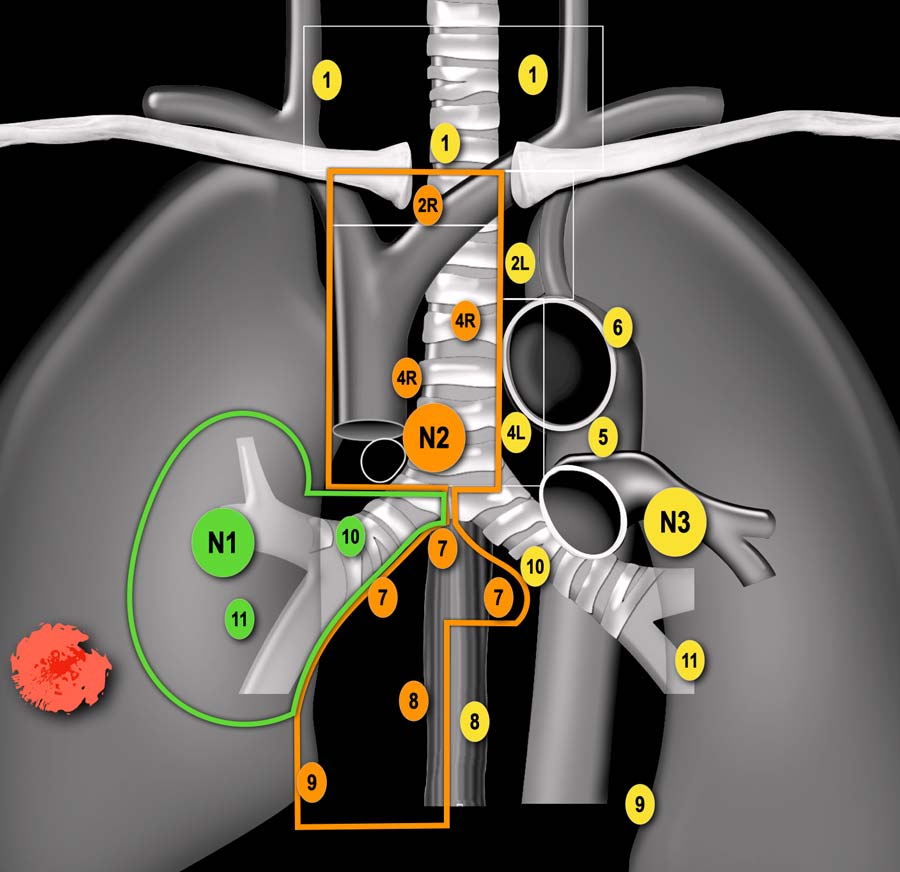N2 küçük hücreli dışı akciğer kanseri