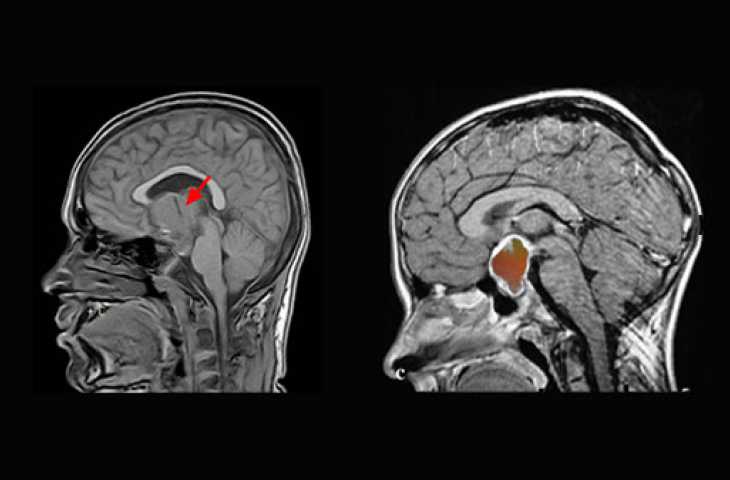 Nadir görülen beyin tümöründe akıllı ilaç ile etkileyici sonuçlar