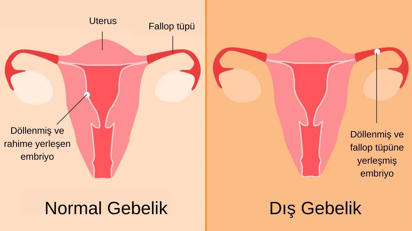 normal ve dis gebelik