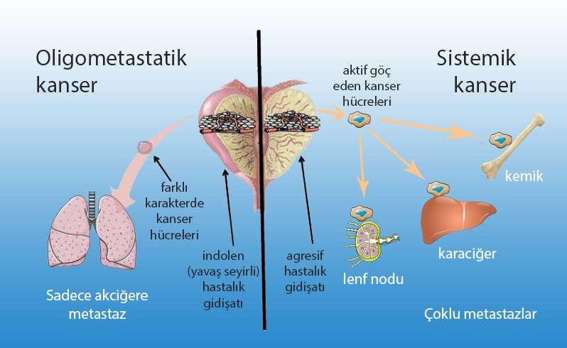 oligometastatik ve sistemik kanser arasındaki farklar nedir