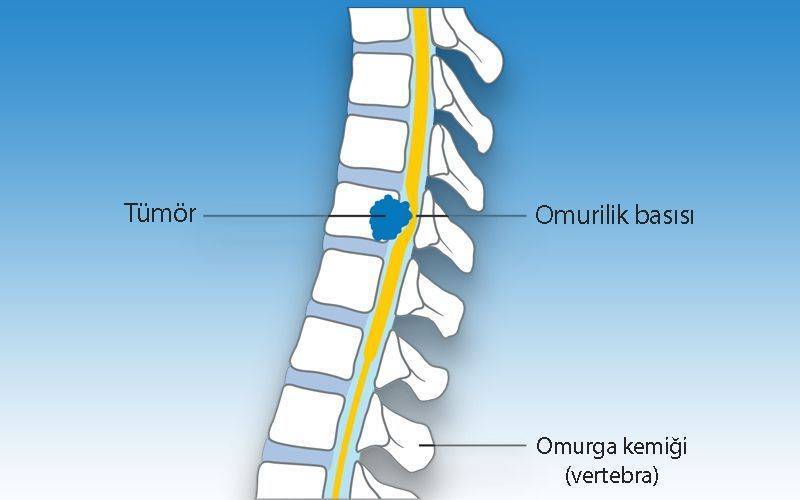 omurilige spinal korda bası yapan bir tümör