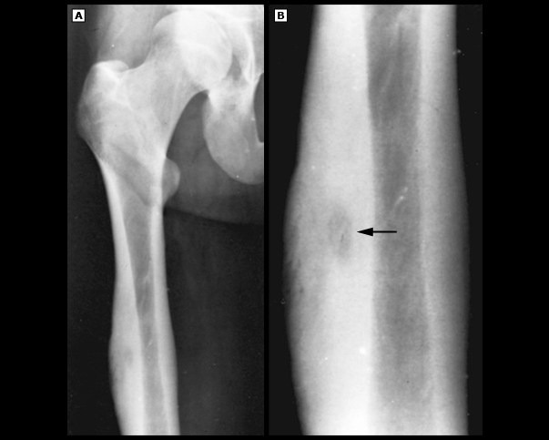 Osteoid osteoma xray radyolojik görüntü