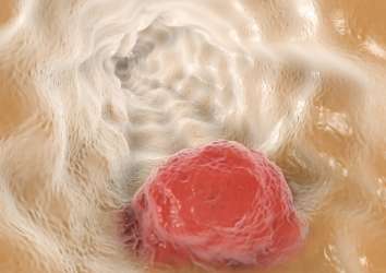Özofagus (yemek borusu) kanseri ikinci basamak tedavisinde immünoterapi nivolumab FDA onayı aldı