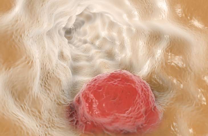 Özofagus (yemek borusu) kanseri ikinci basamak tedavisinde immünoterapi nivolumab FDA onayı aldı