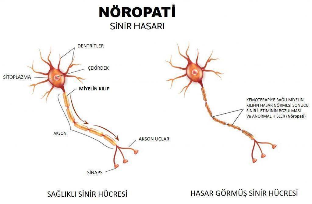 periferal nöropati kemoterapiye bağlı sinir hasarı 1024x668