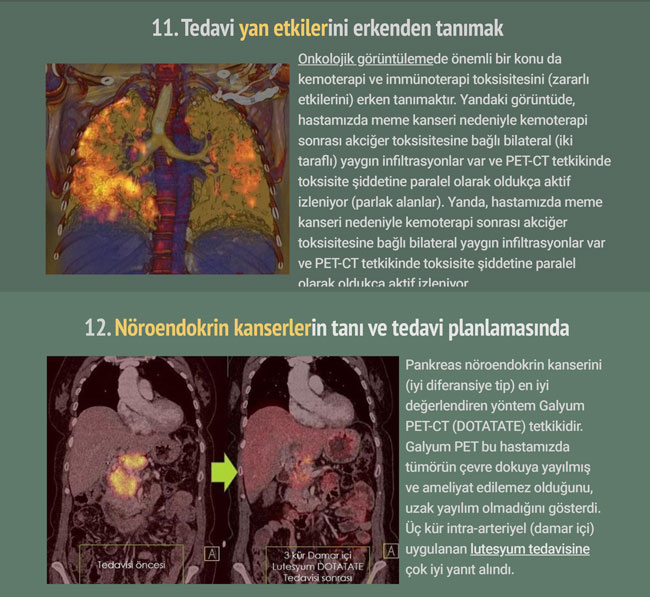 pet bt pozitron emisyon tomografisi nedir tarihcesi (6)
