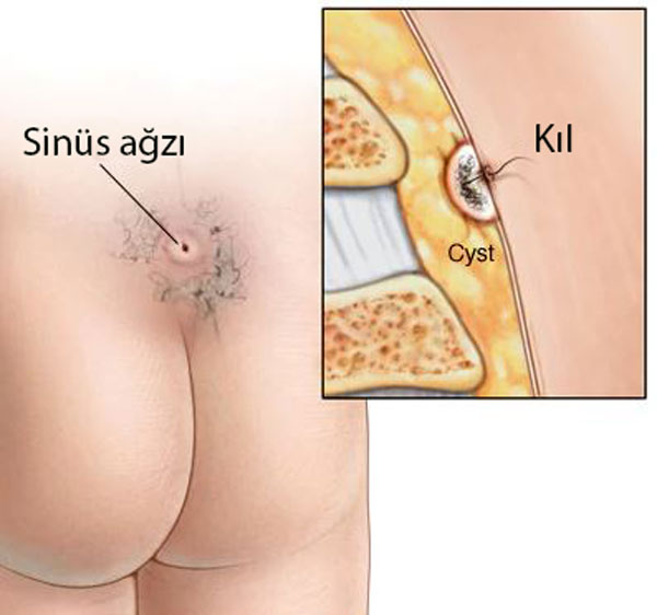 pilonidal kist nedir kıl dönmesi