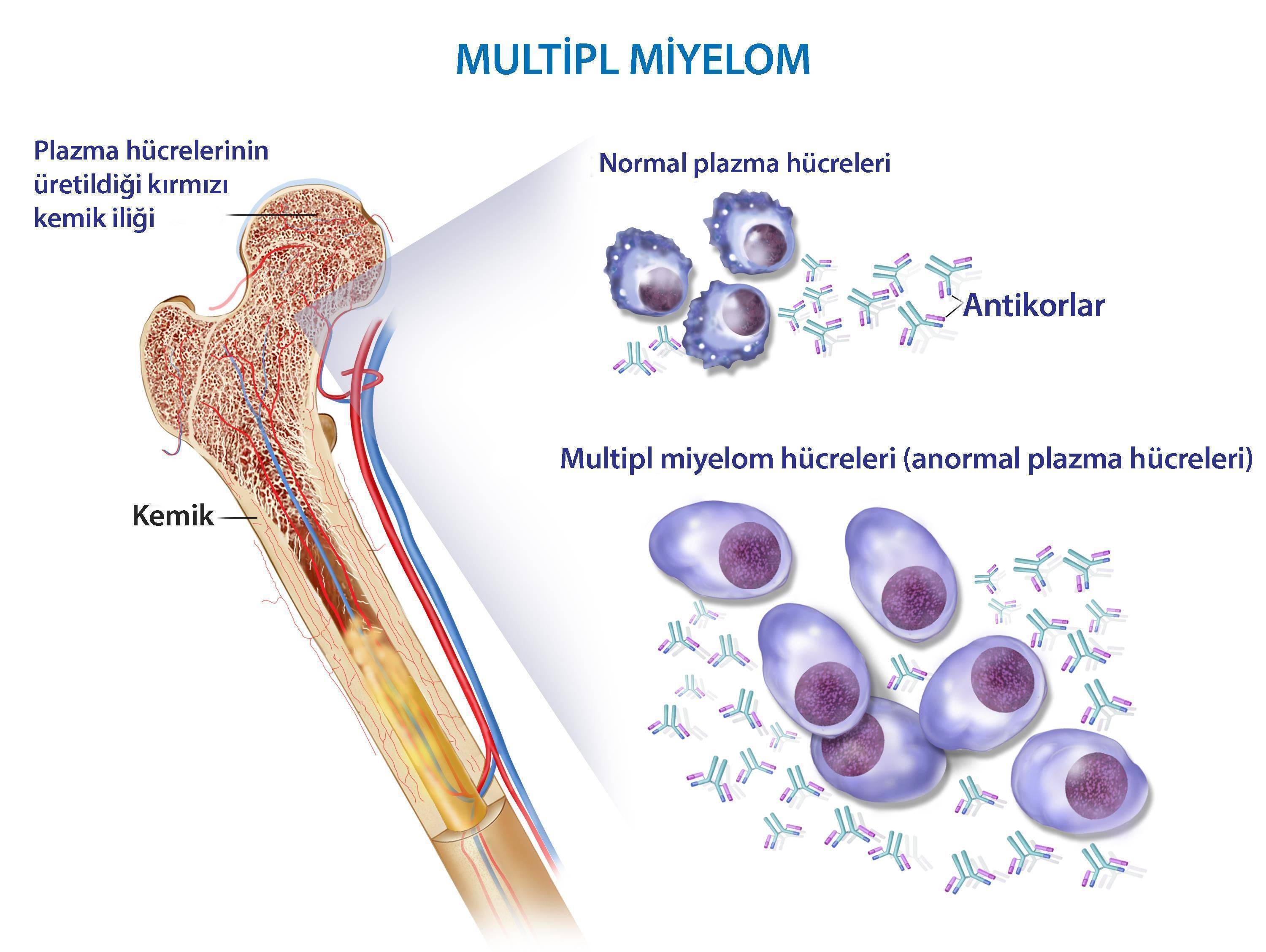 plazma hücreleri anormal antikor üretimi multiple myeloma