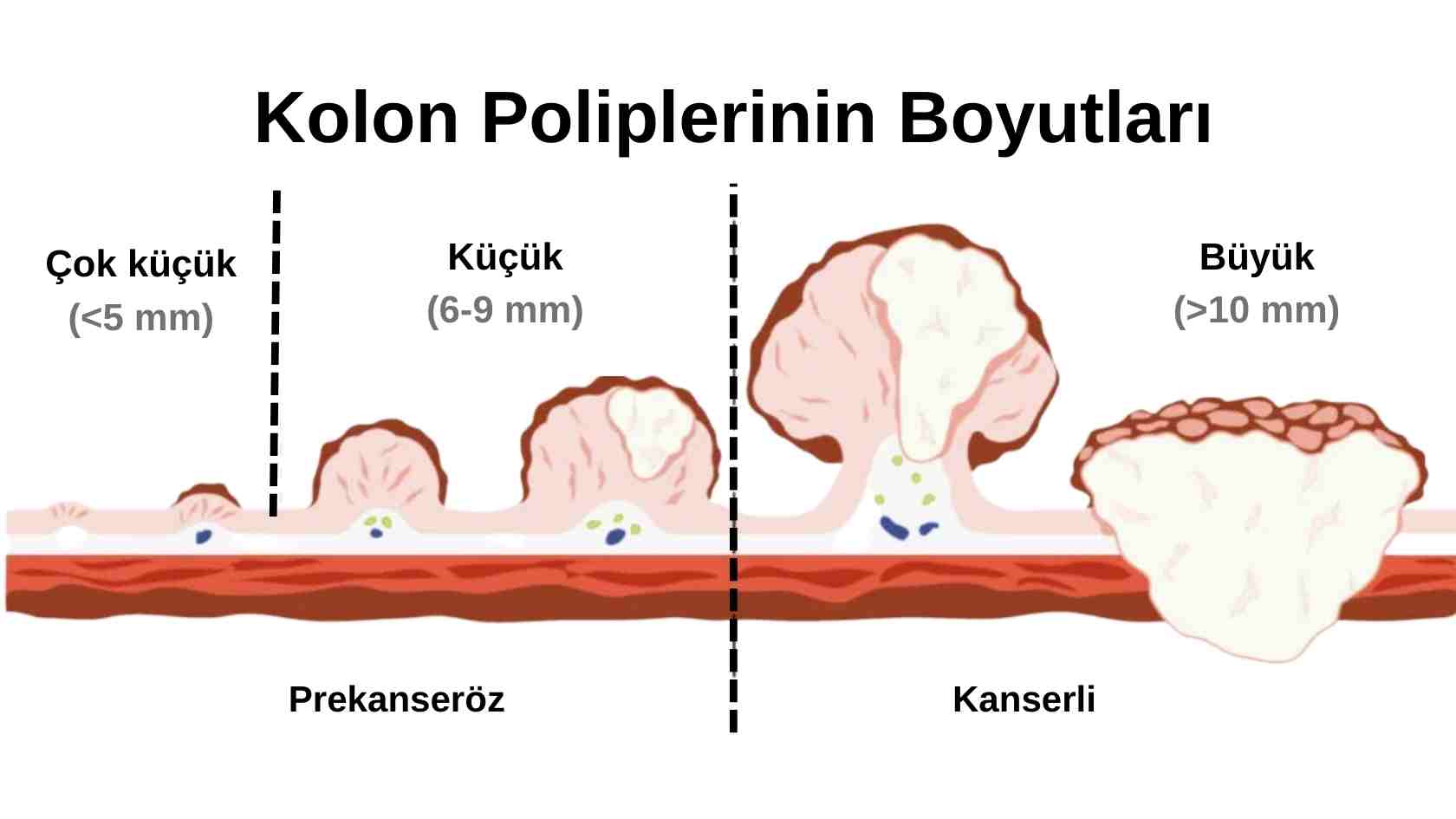 polip boyutlari