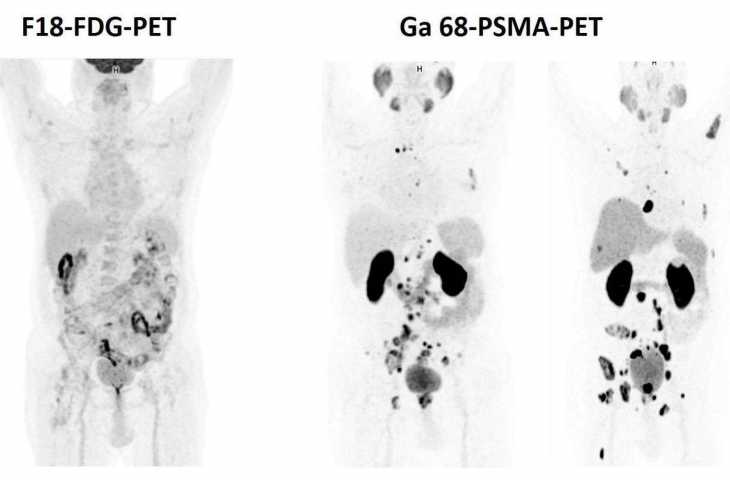 PSMA-PET Nedir? Prostat Kanseri Yayılımı için Neden En İyi Görüntüleme Yöntemidir?