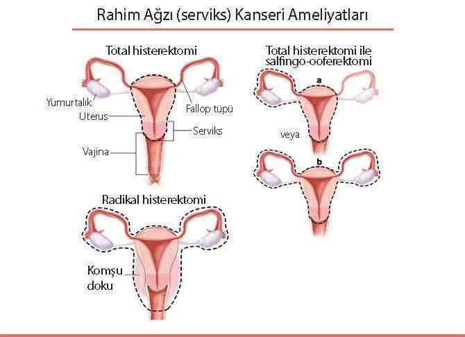 rahim ağzı kanser ameliyatı histerektomi serviks kanseri