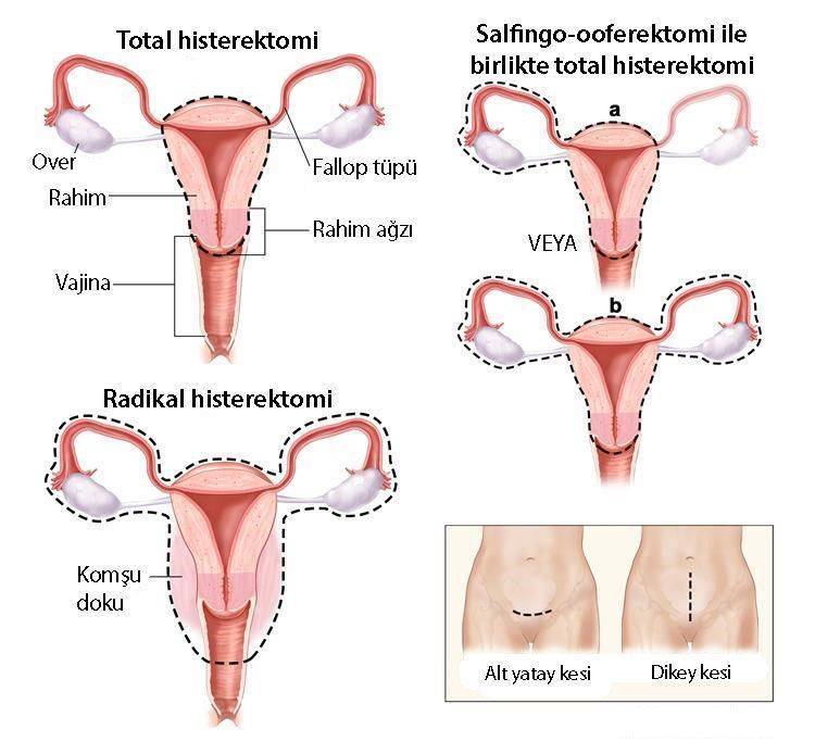 rahim kanseri ameliyatı radikal histerektomi total histerektomi salfingo ooferektomi