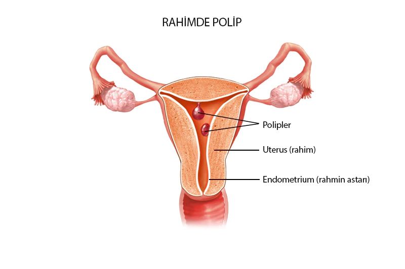 rahim polip endometrium uterin nedir