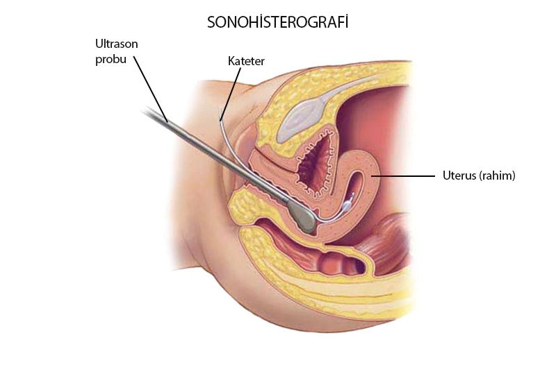 sonohisterografi histeroidografi nedir