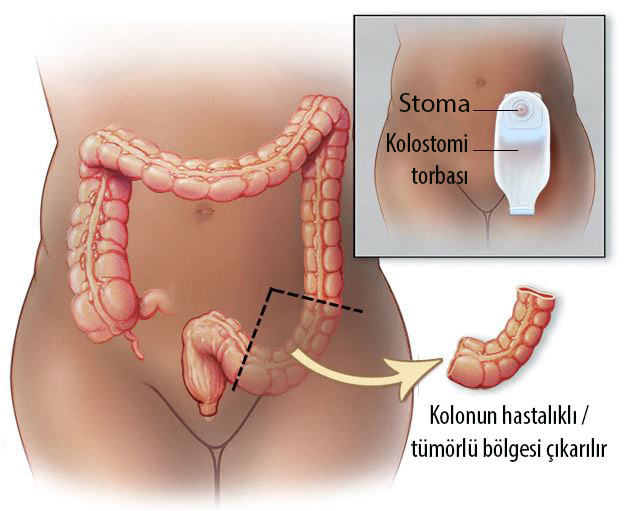 stoma kolestomi torbası nedir kolon kanseri