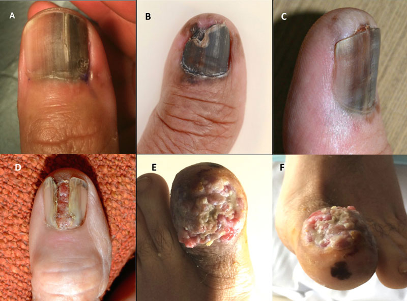 subungual melanomun klinik görünümlerinin bir spektrumu tırnak melanomu çeşitleri