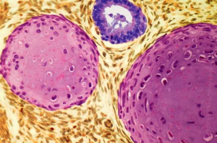 Teratom Nedir? Belirtileri, Nedenleri ve Tedavisi