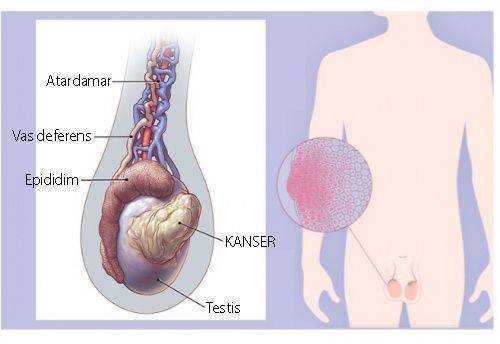 testis kanseri