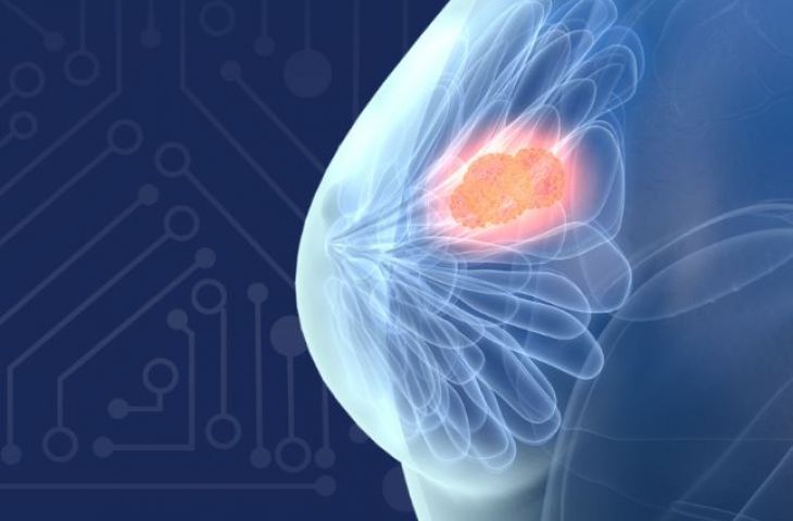Dijital meme tomosentezi için yapay zeka teknolojisi, FDA onayı aldı