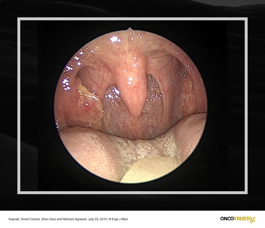 tonsil bademcik kanseri