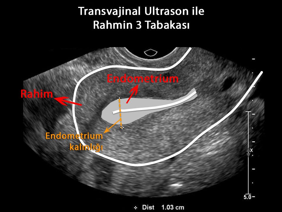 transvajinal ultrason ile rahim endometrium tabakaları kalınlaşma
