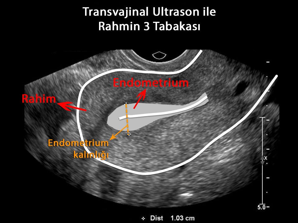rahim duvarı kalınlaşması soru