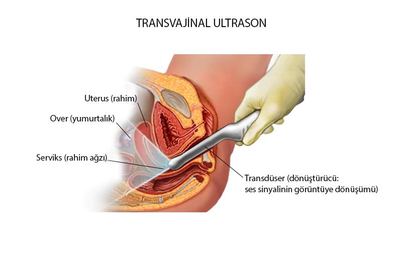 transvajinal ultrason nedir