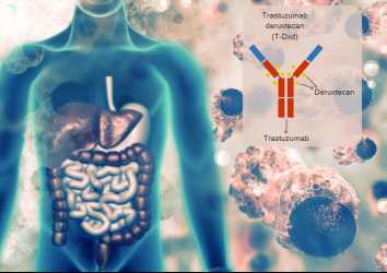 Tümör Agnostik (Bağımsız) Yeni Bir Kanser İlacı Fark Yaratıyor: Trastuzumab Deruxtecan