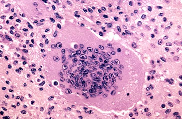 Tenosinovyal Dev Hücreli Tümör Tedavisi İçin Pexidartinib FDA Onayı Aldı