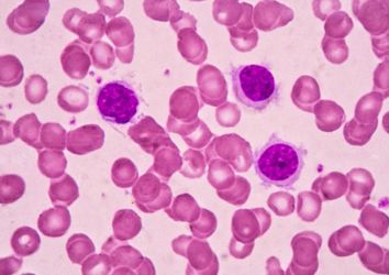 Tüylü Hücre Lösemi tedavisinde Moxetumomab Pasudotox-tdfk FDA onayı aldı