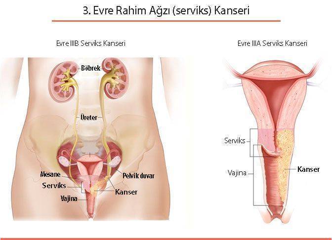 üçüncü evre 3 rahim ağzı serviks kanseri