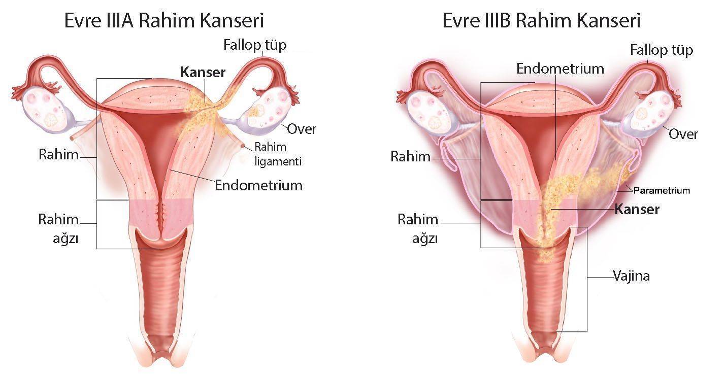 üçüncü evre rahim kanseri evre 3a ve 3b