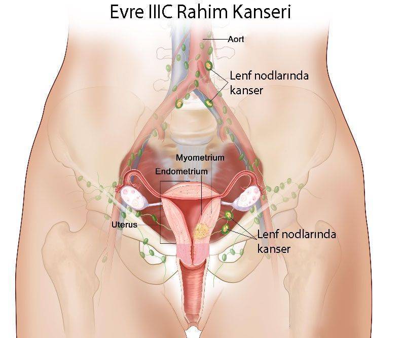 üçüncü evre rahim kanseri evre 3c