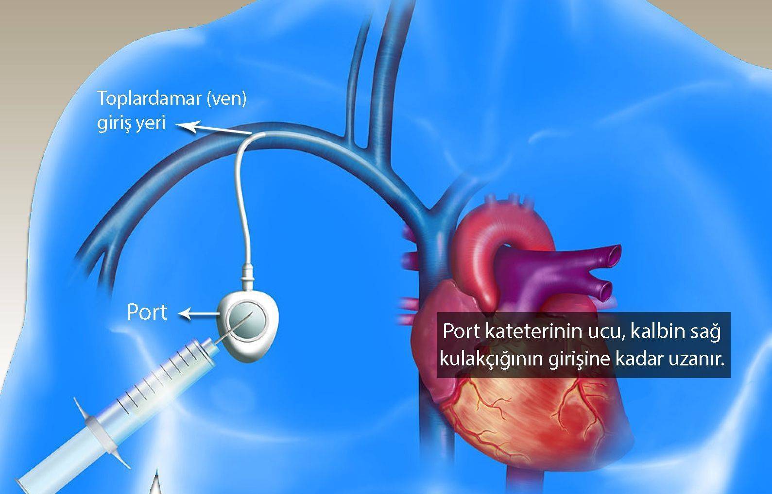 venöz port kateteri nedir santral venöz kateter onkoloji