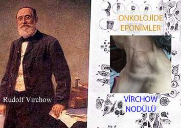 Virchow Nodülü Nedir? Adı Nereden Gelmektedir?