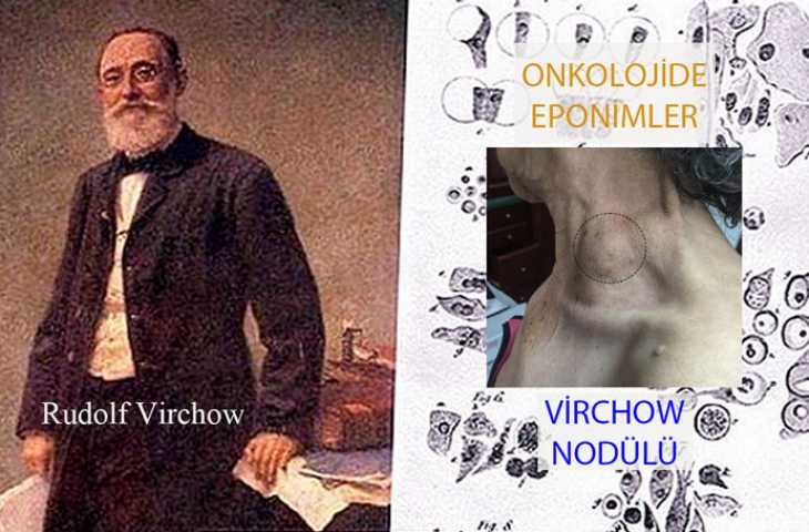 Virchow Nodülü Nedir? Adı Nereden Gelmektedir?