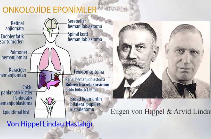 Von Hippel-Lindau Hastalığı Nedir? Adı Nereden Gelmektedir?