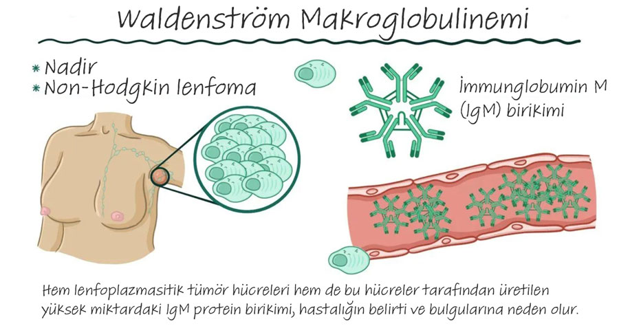 Waldenström Makroglobulinemi mekanizması infografi