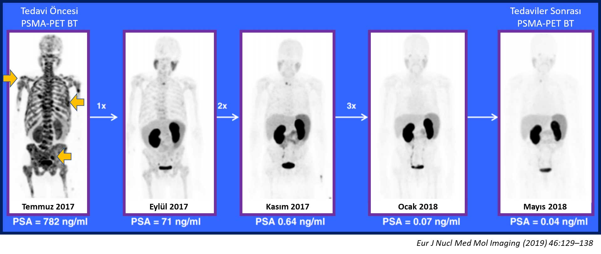 yeni tanı evre 4 prostat kanserinde aktinyum tedavisi ile radyolojik tam yanıt ve psa düşme