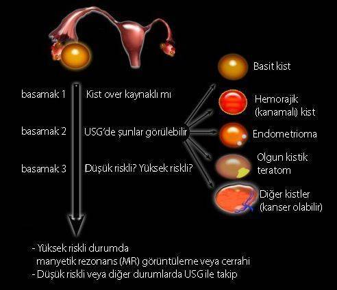 yumurtalık over kisti teşhisinde ultrason usg basamakları